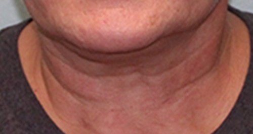 Facelift af  hals eller kinder