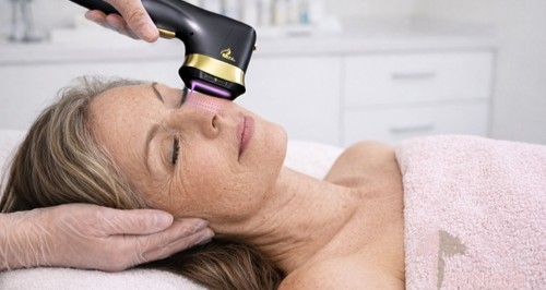 HIFU 13D – Hele ansigtet