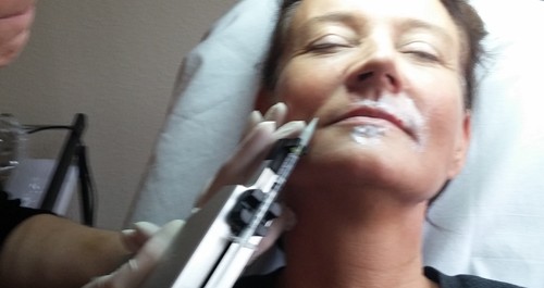 Meso Therapy helt ansigt